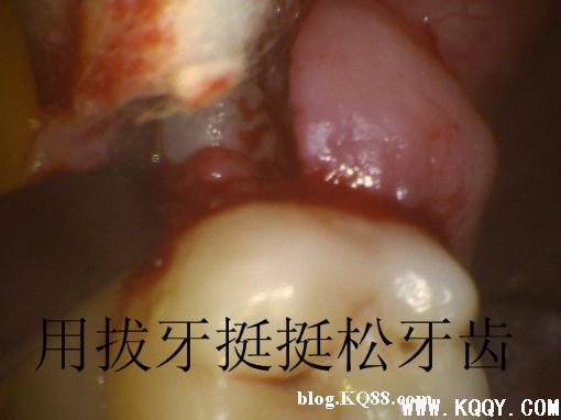 上颌高位阻生智齿的微创拔除过程图