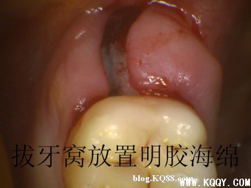 上颌高位阻生智齿的微创拔除过程图