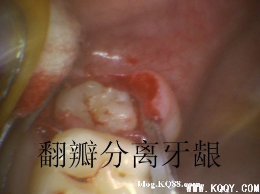 上颌高位阻生智齿的微创拔除过程图