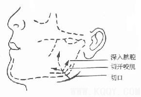 颌周峰窝织炎——口腔颌面部炎症