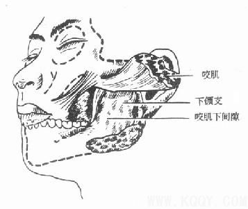 颌周峰窝织炎——口腔颌面部炎症