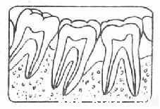 口腔颌面常见疾病——单纯性牙周炎