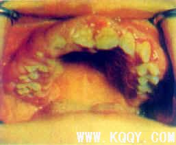 口腔颌面常见疾病——肥大性龈炎