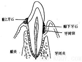 口腔颌面常见疾病——单纯性牙周炎