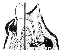 口腔颌面常见疾病——单纯性牙周炎