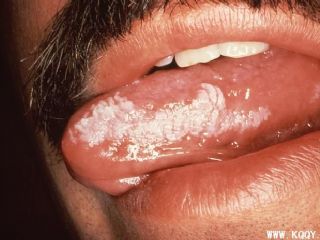 艾滋病口腔表现：口腔白斑