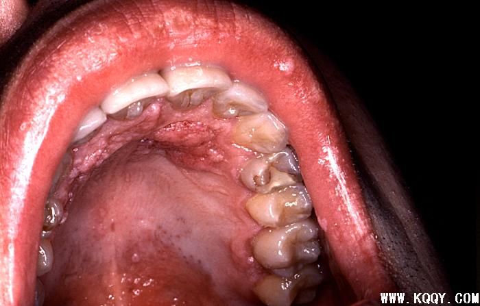 艾滋病口腔表现：口腔疣
