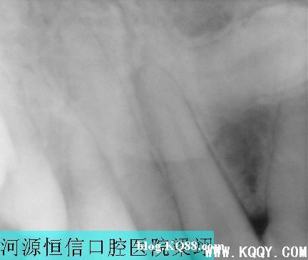 x光片导致埋伏牙拔除判断失误