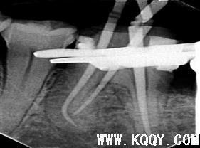 下颌磨牙的根管再治疗病例一例及技巧总结