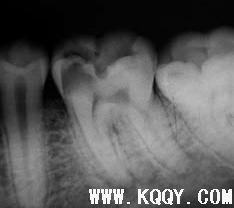 下颌第一恒磨牙根管系统详解