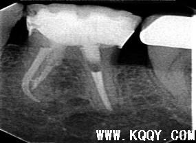 下颌磨牙的根管再治疗病例一例及技巧总结