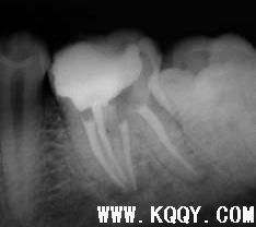 下颌第一恒磨牙根管系统详解