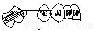 片段弓矫治技术的临床研究