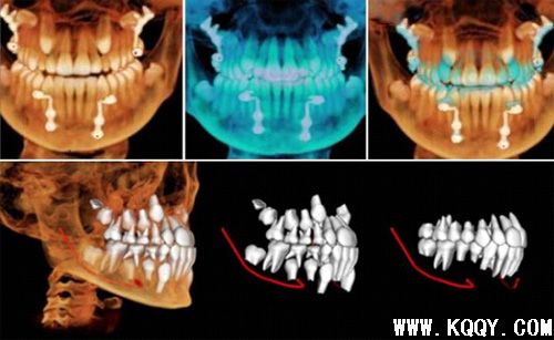 KaVo 3D口腔锥体束CT简介