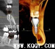 KaVo 3D口腔锥体束CT在口腔种植的应用