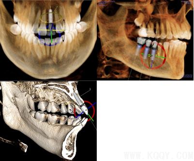 KaVo 3D口腔锥体束CT在口腔种植的应用
