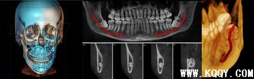 KaVo 3D口腔锥体束CT在口腔种植的应用