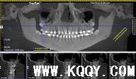 KaVo 3D口腔锥体束CT在口腔种植的应用