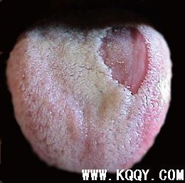 舌鹅口疮图片