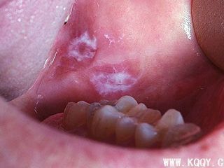 口腔黏膜白斑图片
