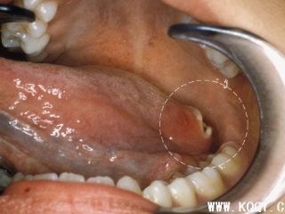 舌底口腔癌图片
