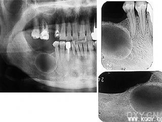 残留牙根囊肿影像学图片