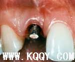 Photo of extension attached to implant