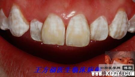 渗透树脂修复氟斑牙病例