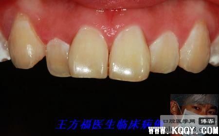 渗透树脂修复氟斑牙病例