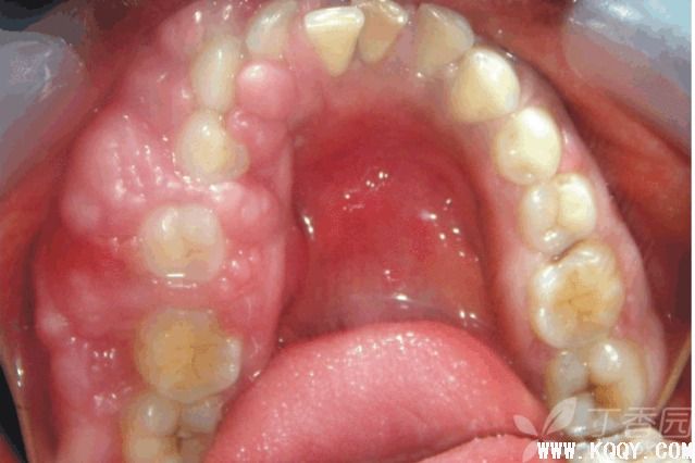 牙龈纤维瘤病
