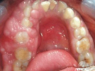 牙龈纤维瘤病