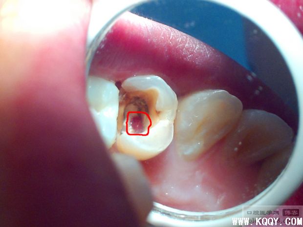 一例前磨牙根管侧穿再治疗
