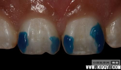 前牙色素斑调磨之染色树脂美容修复