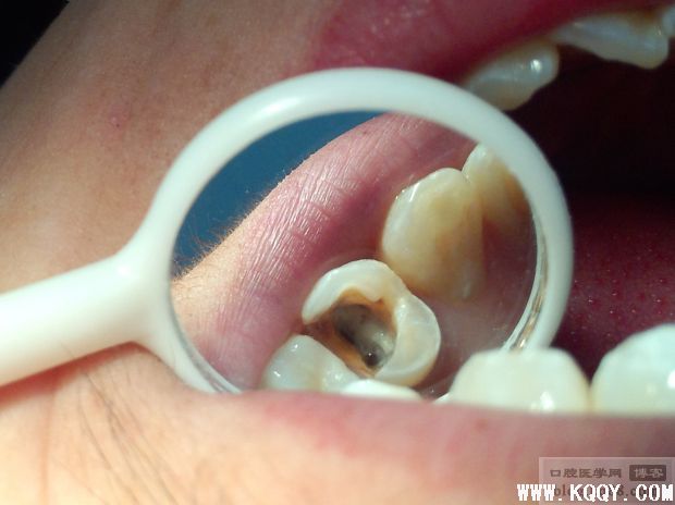 一例前磨牙根管侧穿再治疗