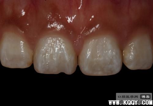 前牙色素斑调磨之染色树脂美容修复