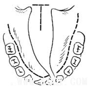 腭裂修复术图解
