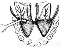 腭裂修复术图解