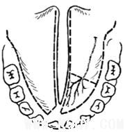 腭裂修复术图解