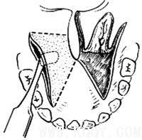 腭裂修复术图解