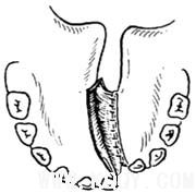 腭裂修复术图解