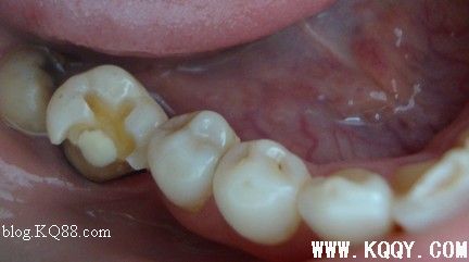 3M树脂分层仿真修复后牙大面积龋齿