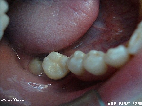 3M树脂分层仿真修复后牙大面积龋齿