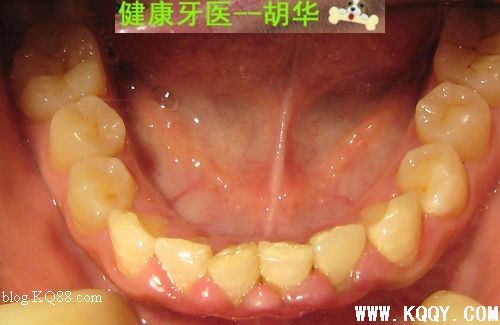 Varios750结合派丽奥治疗顽固性慢性龈缘炎