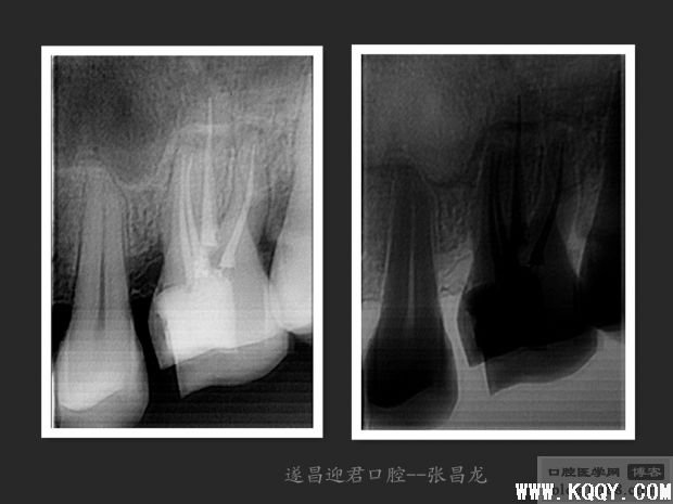 别让遗漏根管成为你的隐形杀手