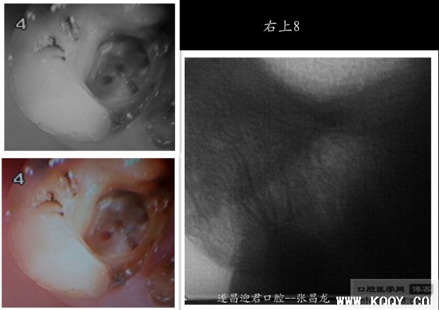 别让遗漏根管成为你的隐形杀手