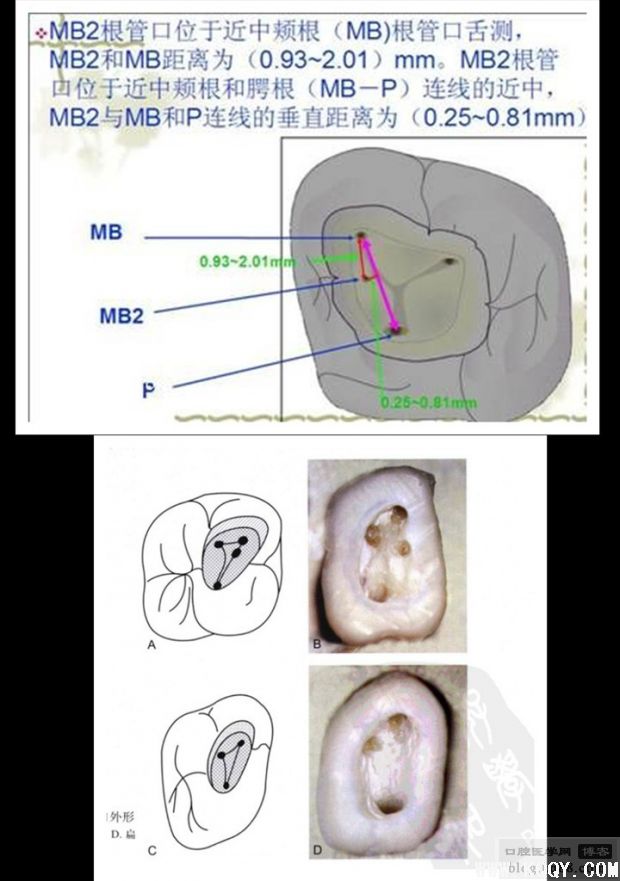 别让遗漏根管成为你的隐形杀手