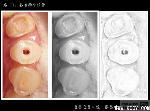 别让遗漏根管成为你的隐形杀手