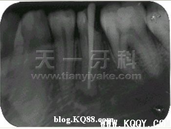 暖牙胶垂直挤压术充填根尖孔外吸收的病例图