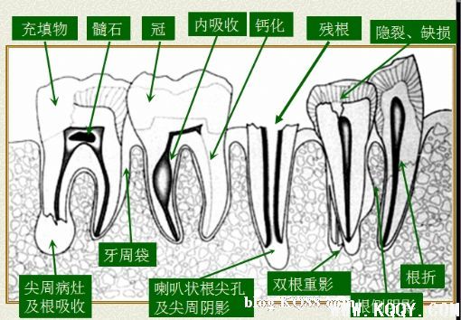 浅析根管口的探查(胡华)