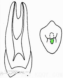 浅析根管口的探查(胡华)